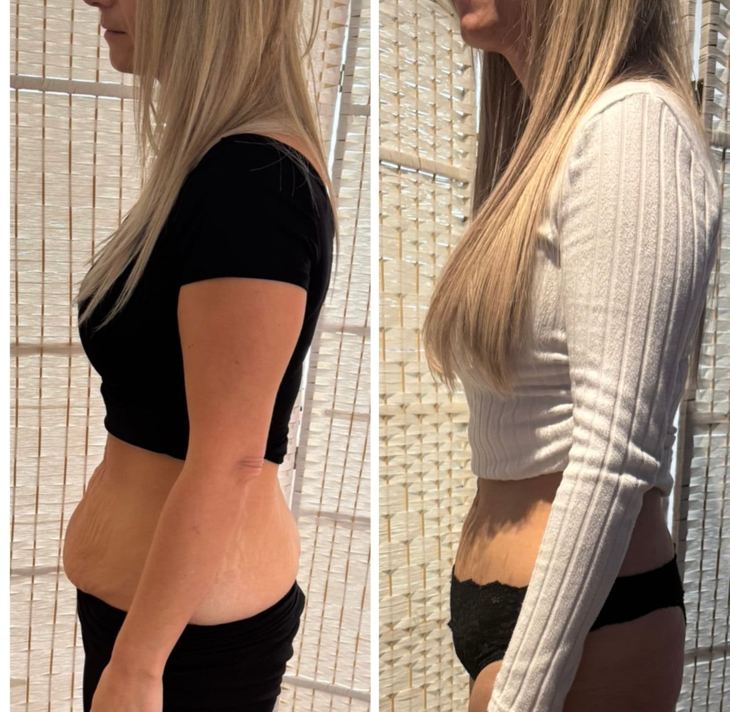 Astrabody result — visible change